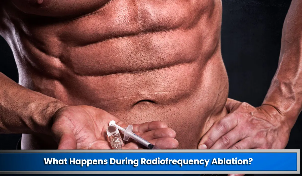 What Happens During Radiofrequency Ablation?